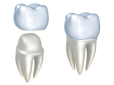 Diagram of dental crowns at Cambridgeside Dental Associates in Cambridge, MA 