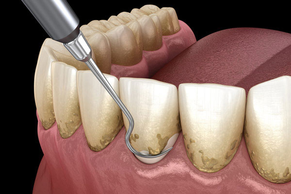 A diagram of  teeth getting roots scaled