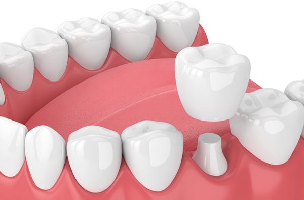 Close up of a computer rendering of a jaw with a dental crown at Cambridgeside Dental Associates in Cambridge, MA