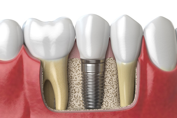 3D rendering of a dental implant next to healthy teeth at Cambridgeside Dental Associates in Cambridge, MA