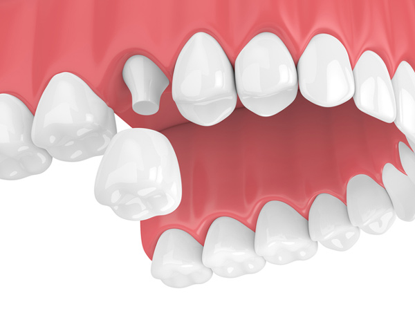 Rendering of jaw with dental crown at Cambridgeside Dental Associates in Cambridge, MA