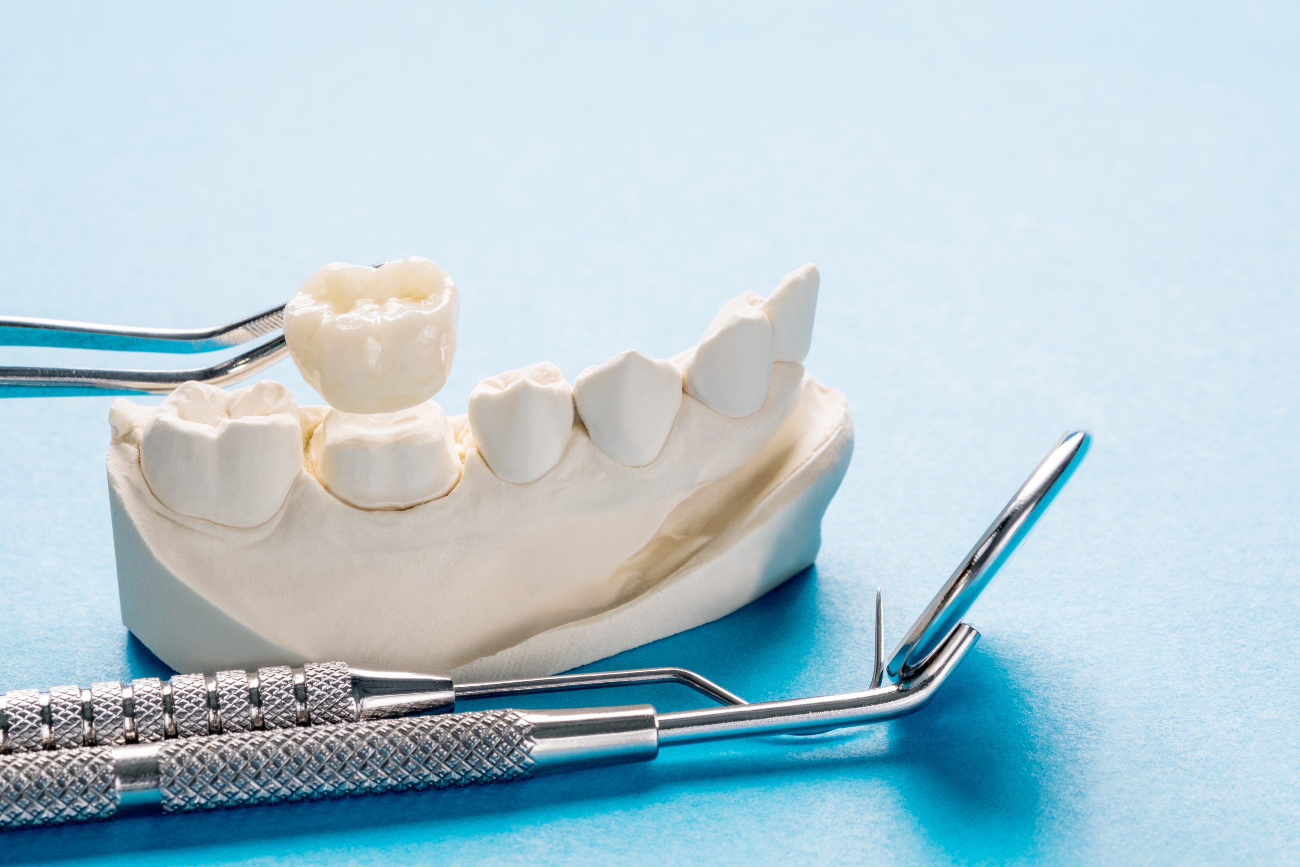 Jaw model with dental crown being applied by dentist instruments on blue background, ideal for illustrating dental procedures and dental care.